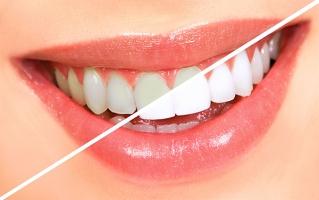 Cách làm trắng răng hiệu quả nhất tại nhà với Baking soda