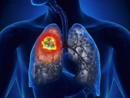 Dấu hiệu nhận biết ung thư phổi giai đoạn đầu