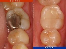 địa chỉ điều trị viêm tủy răng hiệu quả hàng đầu tại Tp HCM