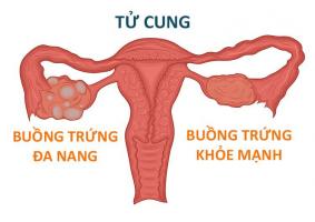 Địa chỉ khám và điều trị buồng trứng đa nang uy tín nhất tại Hà Nội