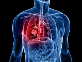 Địa chỉ tầm soát ung thư phổi tốt nhất tại TP. HCM