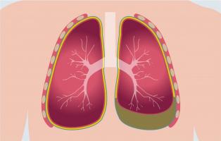 Lưu ý quan trọng nhất về bệnh viêm màng phổi