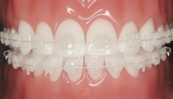 Nha khoa niềng răng mắc cài sứ dây trong uy tín nhất TP. HCM