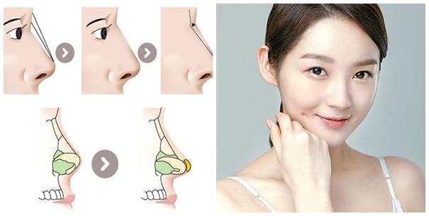 Top 8 Địa chỉ nâng mũi sụn tự thân uy tín nhất tại TP.HCM