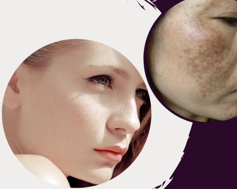 Top 11 Spa trị nám tại Cần Thơ: uy tín, hiệu quả nhất