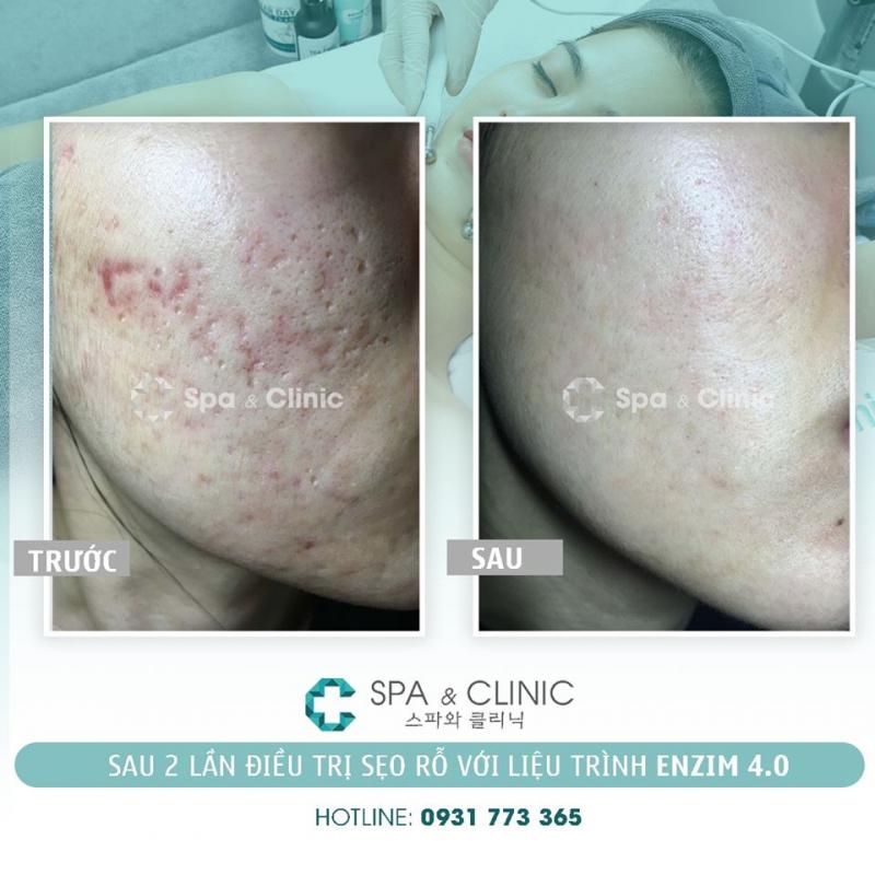 C Spa & Clinic - Trị Sẹo Rỗ