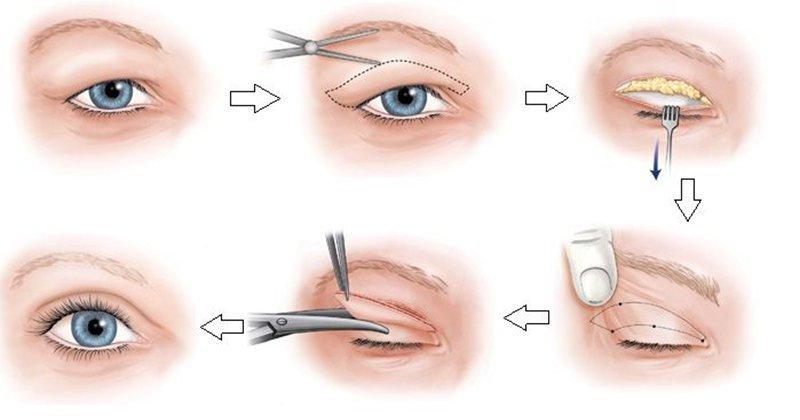 Top 8 Địa chỉ cắt mí, nhấn mí đẹp và an toàn nhất Cần Thơ