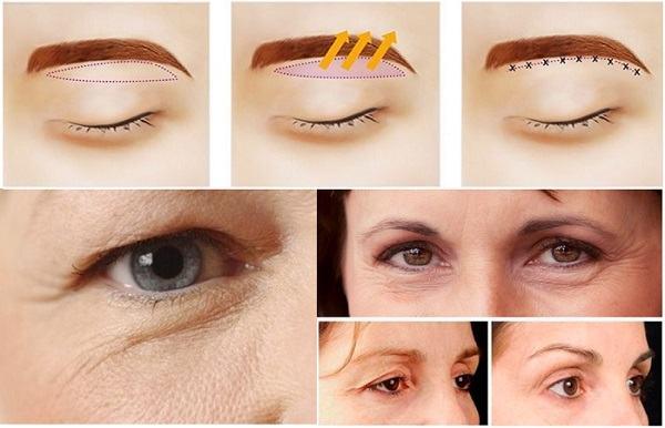 Top 5 Địa chỉ nâng cung chân mày đẹp, uy tín nhất tỉnh Ninh Thuận