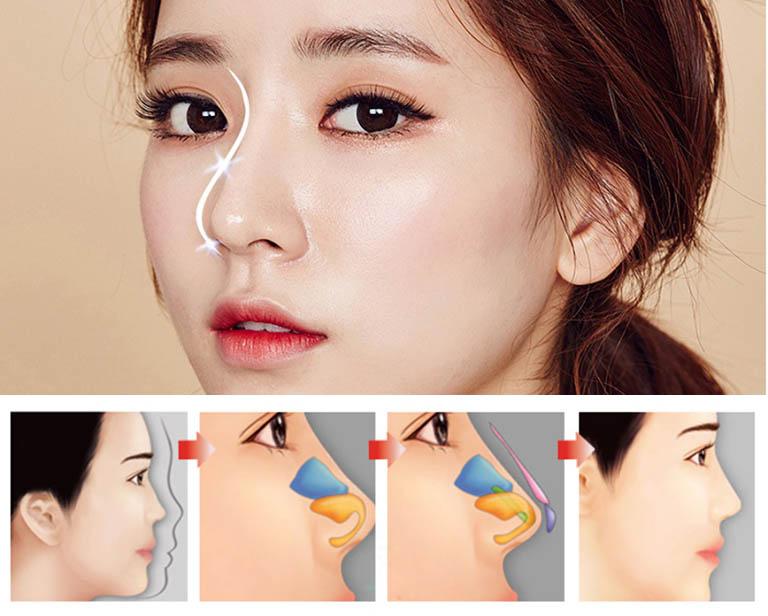 Top 4 Địa chỉ nâng mũi đẹp và an toàn nhất tỉnh Ninh Thuận
