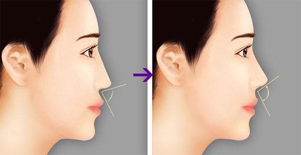 Top 4 Địa chỉ nâng mũi đẹp và an toàn nhất tỉnh Kon Tum