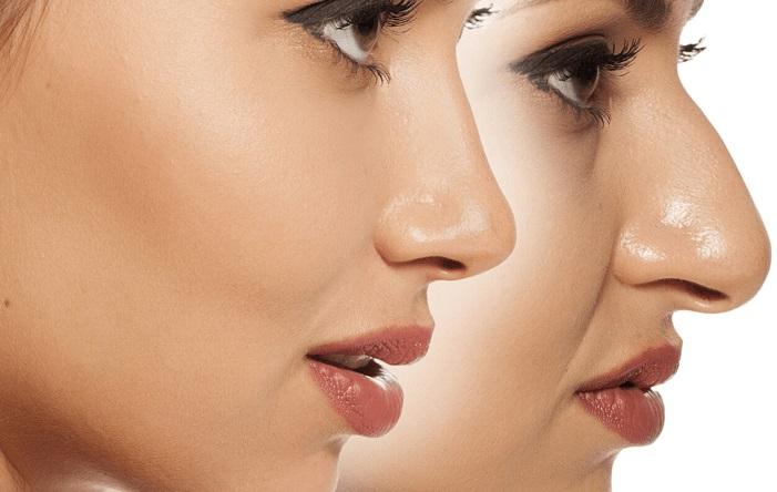 Top 8 Địa chỉ nâng mũi đẹp và an toàn nhất TP. Vinh, Nghệ An