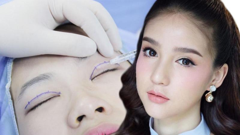 Top 6 Địa chỉ nhấn mí, cắt mí đẹp, an toàn nhất TP. Nha Trang, Khánh Hòa