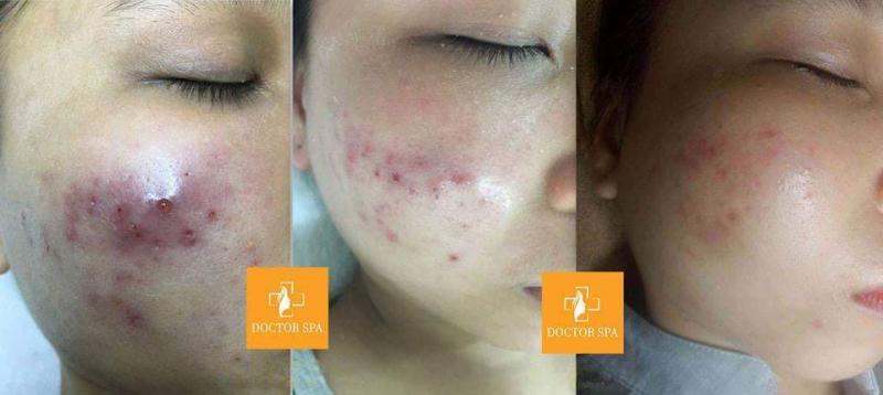 Doctor Spa - Trị Mụn Chuyên Sâu