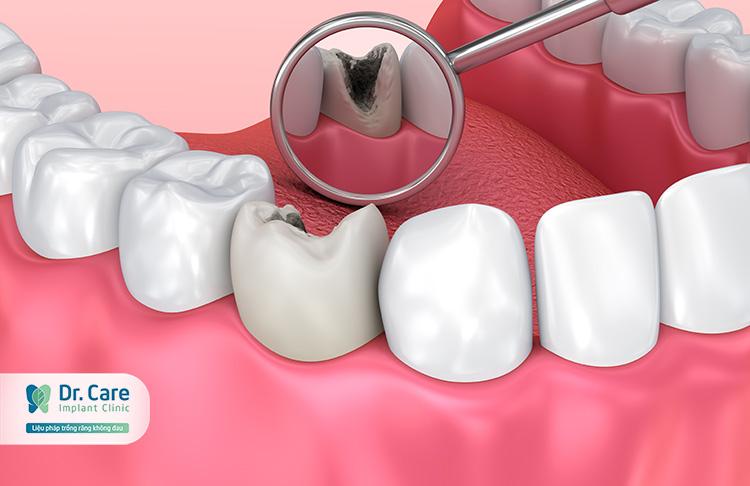 Top 8 sản phẩm đặc trị sâu răng gia truyền hiệu quả nhất hiện nay