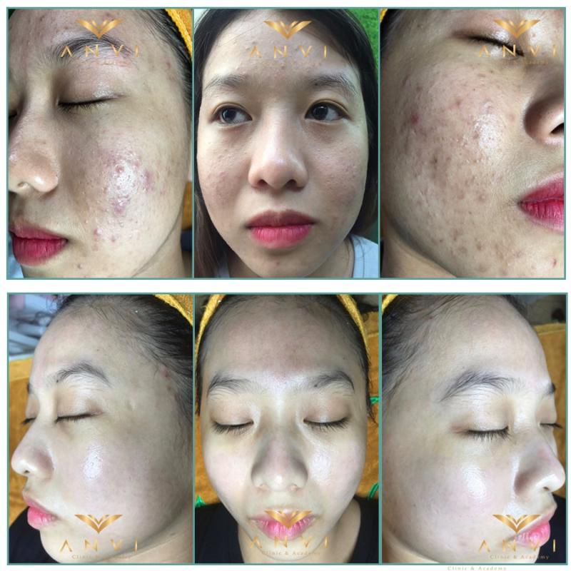 Viện Điều Trị Sẹo Rỗ Anvi Spa CLinic