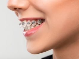 Điều cần biết về niềng răng mắc cài kim loại