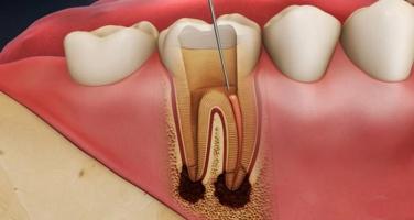 Top 10 Địa chỉ điều trị viêm tủy răng hiệu quả hàng đầu tại TP. HCM