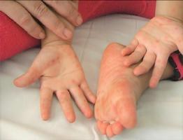 Địa chỉ khám và điều trị bệnh tay chân miệng ở trẻ em tốt nhất tại Hà Nội