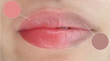 Địa chỉ khử thâm môi tại Cần Thơ hiệu quả, đẹp tự nhiên nhất