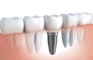 Địa chỉ trồng răng implant tốt nhất tỉnh Gia Lai
