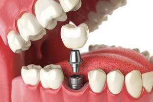 Địa chỉ trồng răng implant uy tín nhất Cần Thơ