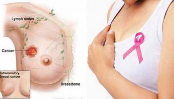 Điều cần biết nhất về căn bệnh ung thư vú