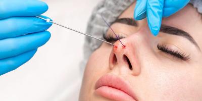 Giải đáp: Nâng mũi không phẫu thuật (tiêm filler, chỉ sinh học) – Có an toàn không? Bao lâu thì tan?