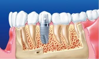 Nha khoa trồng răng implant uy tín nhất quận 3, TP. HCM