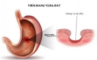 Chuyên gia khám chữa đau dạ dày giỏi nhất tại Hà Nội