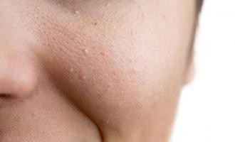 Phòng Khám Trị Mụn Thịt, Mụn Cóc Uy Tín Nhất Tại Hà Nội