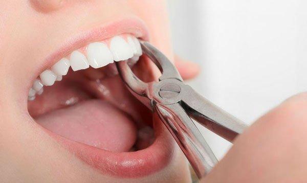 Top 11 Nha khoa nhổ răng khôn uy tín, chất lượng nhất tại Hà Nội - Toplist.vn