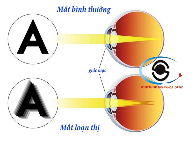 Loạn thị làm chúng ta nhìn mờ ở mọi khoảng cách