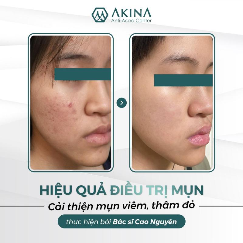 AKINA Anti Acne - BS Cao Nguyên