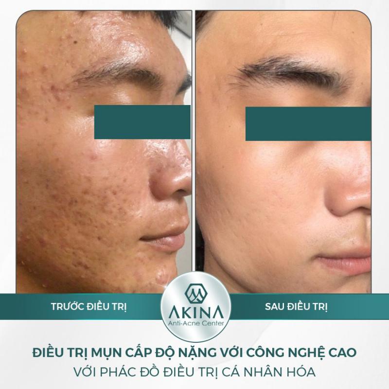 AKINA Anti Acne - BS Cao Nguyên