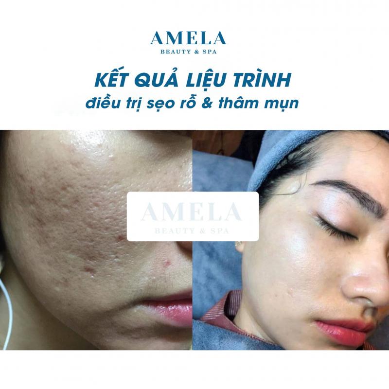 Amela Beauty - Trị Mụn Trị Sẹo Chuẩn Y Khoa