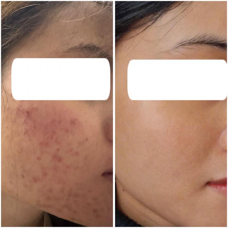 ASANA Spa & Beauty - Chuyên Gia Trị Mụn Hàng Đầu Đà Lạt