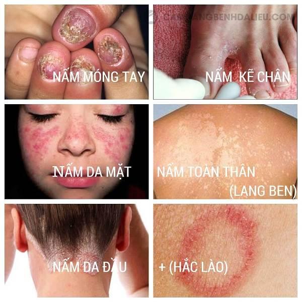 Nên thăm khám các bệnh lý da liễu càng sớm càng tốt