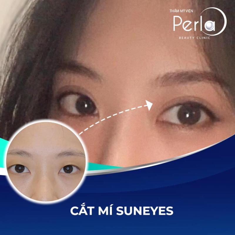 Cắt mí Suneyes tại Perla