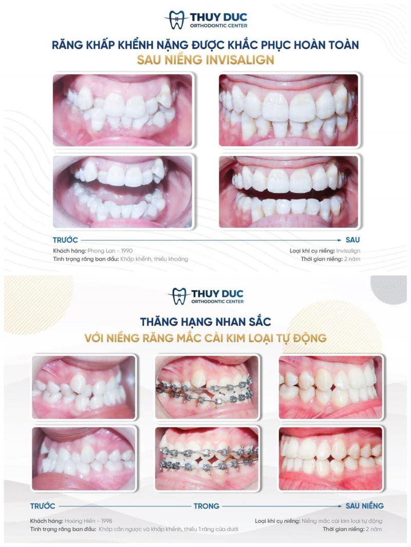 Kết quả niềng răng tại Nha khoa Thúy Đức