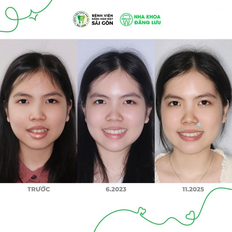 Khách hàng niềng răng tại Nha Khoa Đăng Lưu