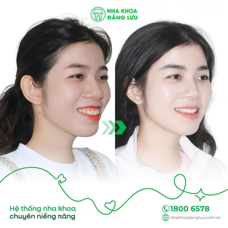 Khách hàng niềng răng tại Nha Khoa Đăng Lưu