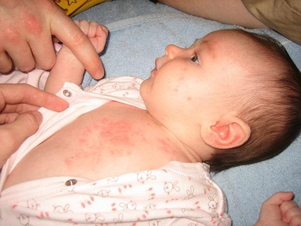 Trẻ mắc bệnh ban đỏ có biểu hiện sốt nhẹ, khó chịu, xuất hiện những mảng đỏ từ 1- 4 ngày ở mặt rồi ban lan xuống cánh tay, toàn thân và chân.