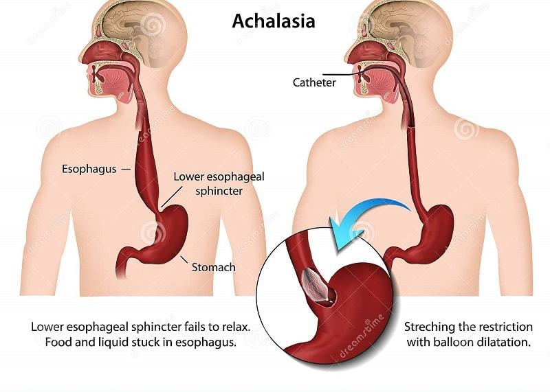 Bệnh co thắt tâm vị (Achalasia)