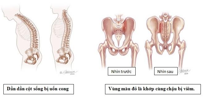 Biểu hiện  và biến chứng của viêm cột sống dính khớp