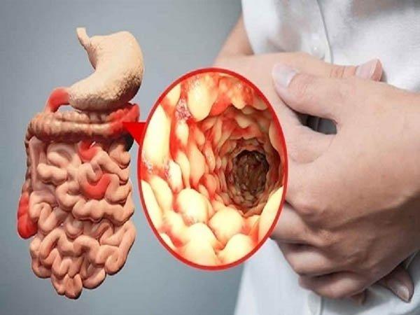 Bệnh Crohn