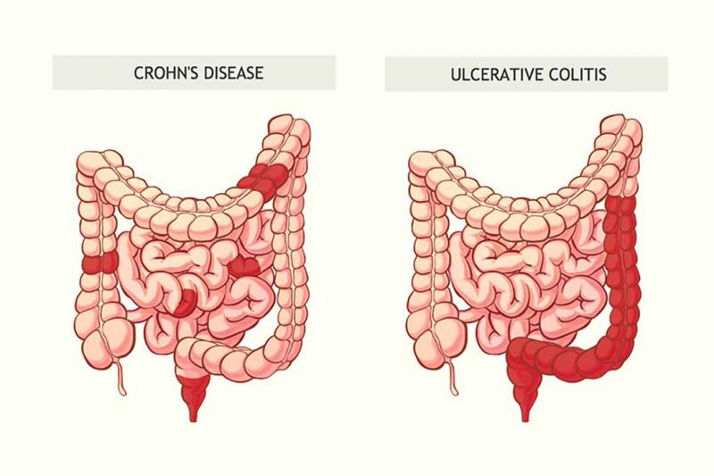 Bệnh Crohn