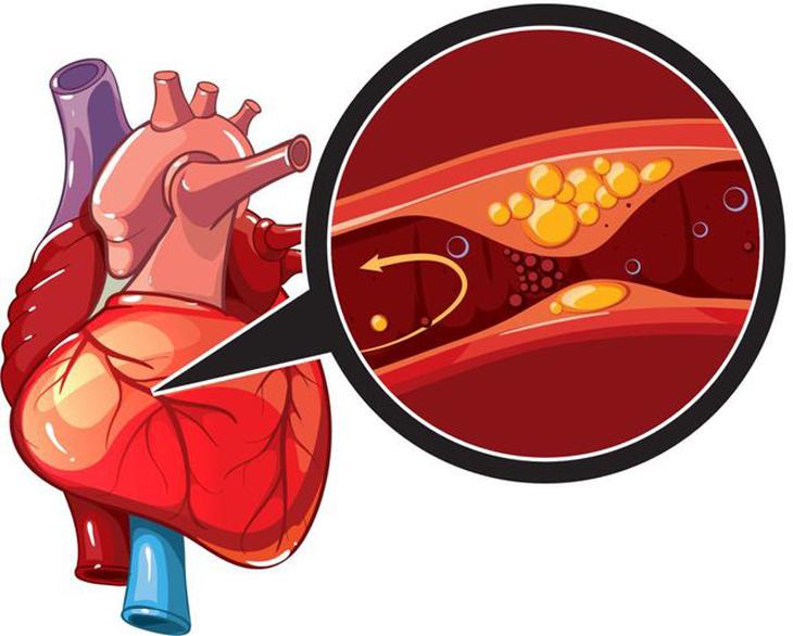 Bệnh mạch vành là gì?