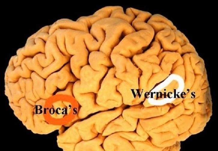 Bệnh não Wernicke