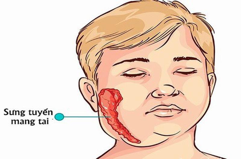 Bệnh quai bị là gì?