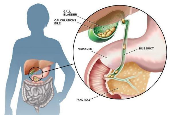 Sỏi mật hình thành khi có quá nhiều cholesterol